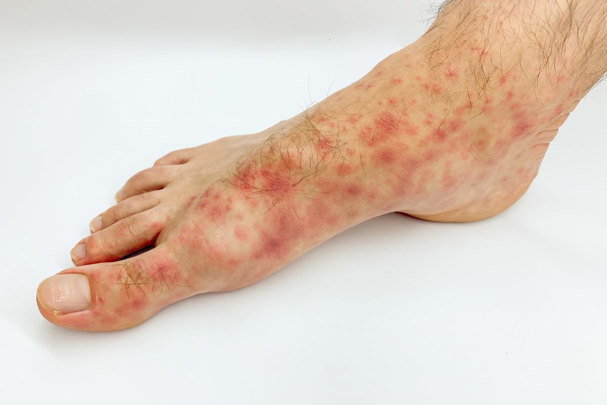 31012586 Close Up Of Males Foot And Toes With Red Rash Desease On A Whit 